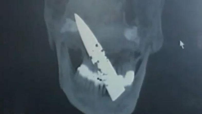 Zdravniki so v glavi Kitajca, ki se je pritoževal nad kroničnimi glavoboli, odkr