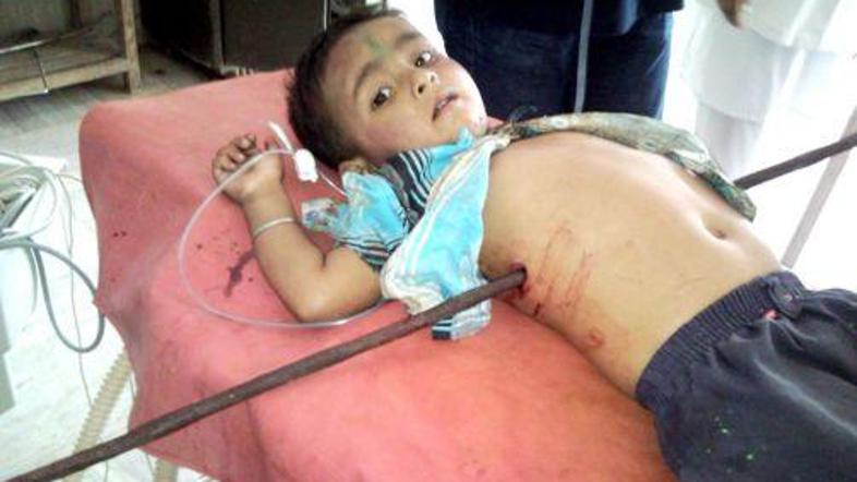 Mali Mihir je kljub nesreči ostal zelo pogumen, so povedali zdravniki.