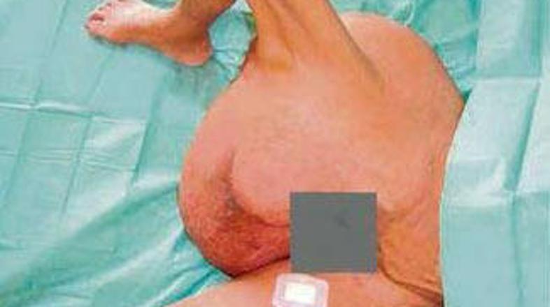 Hondrosarkom je maligni tumor, ki najpogosteje napade ljudi med 30. in 50. letom