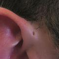  preauricular sinu