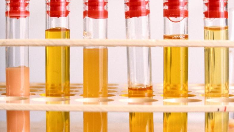 Hiperholesterolemija