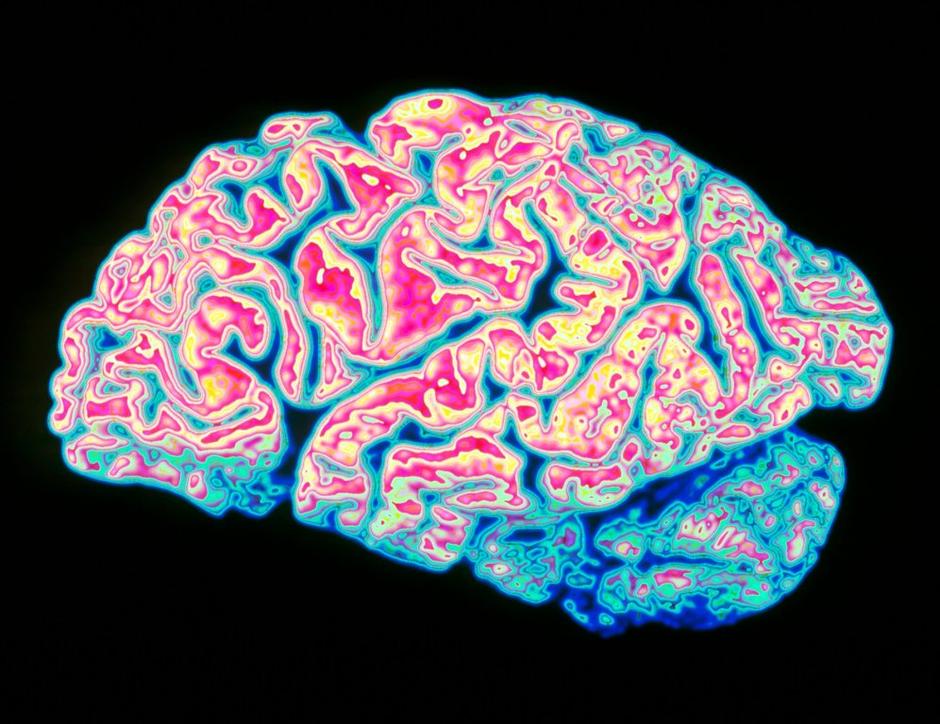 Možgani Alzheimerjeva bolezen | Avtor: Profimedias