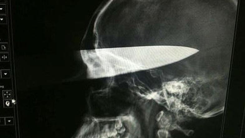 Rentgen je pokazal, kako globoko se je zaril nož. (Foto: smh.com)
