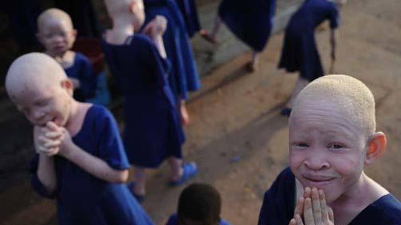Albino otroci so pogosto tarče napadalcev, ki jih hladnokrvo ubijejo in razkosaj