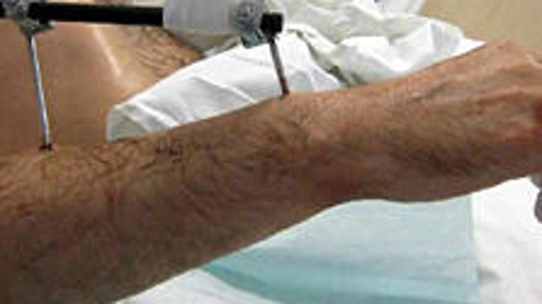 Nemškemu kmetu, ki je v nesreči pred šestimi leti izgubil obe roki, so kirurgi u