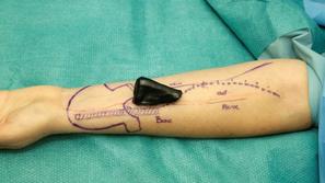 Mikrokirurška rekonstrukcija nosu v UKC Ljubljana