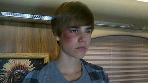 Justin je modrico dobil na snemanju serije Na kraju zločina. (Foto: Twitter)