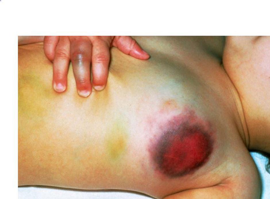 Hemofilija | Avtor: Profimedias