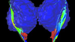 Parkinsonova bolezen