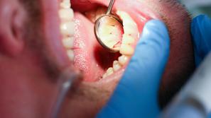 Zobje zobozdravnik karies