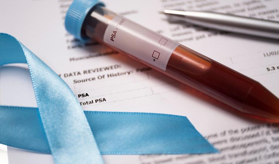 Preprost test, s katerim odkrijejo, ali imate raka