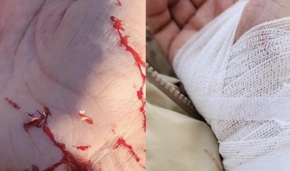 Piknik se je za znano Slovenko končal krvavo