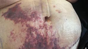 Zapleti po liposukciji