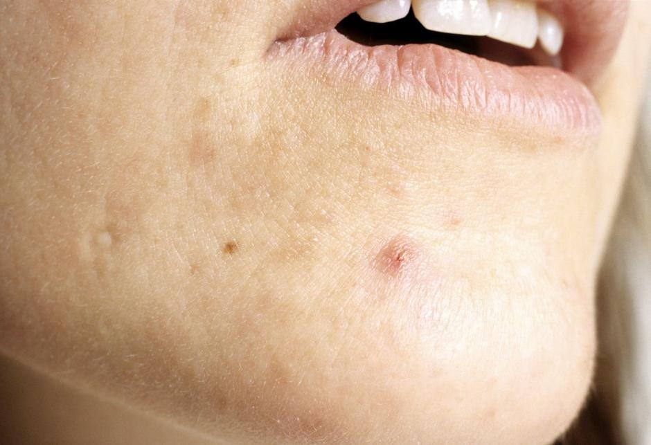 Akne | Avtor: Profimedias