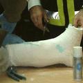 Mavec, s katerim je obdal zlomljeno nogo, je bil narejen iz kokaina.