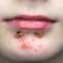 Impetigo