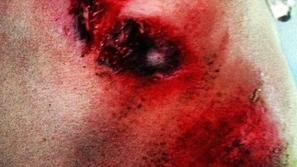 Jani Brajkovič Tour padec rama