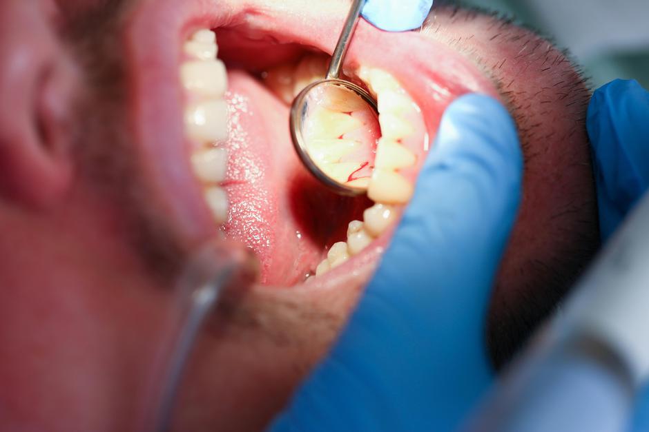 Zobje zobozdravnik karies | Avtor: Profimedia