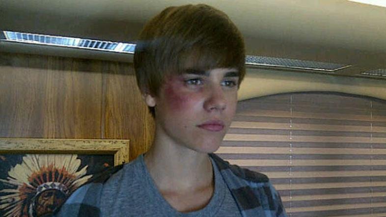 Justin je modrico dobil na snemanju serije Na kraju zločina. (Foto: Twitter)