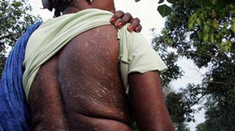 Prebivalci Slonokoščene obale so zaradi stika z nevarnim odpadom preplavili boln