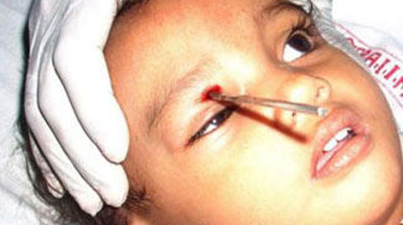 Mala Kumkum je imela srečo v nesreči, saj se njen vid ob nesreči ni poškodoval.