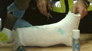 Mavec, s katerim je obdal zlomljeno nogo, je bil narejen iz kokaina.