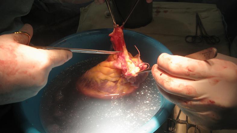 Transplantacija srca