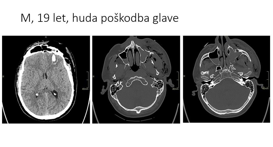 Poškodbe zaradi e-skirojev | Avtor: UKC/Uroš Tominc
