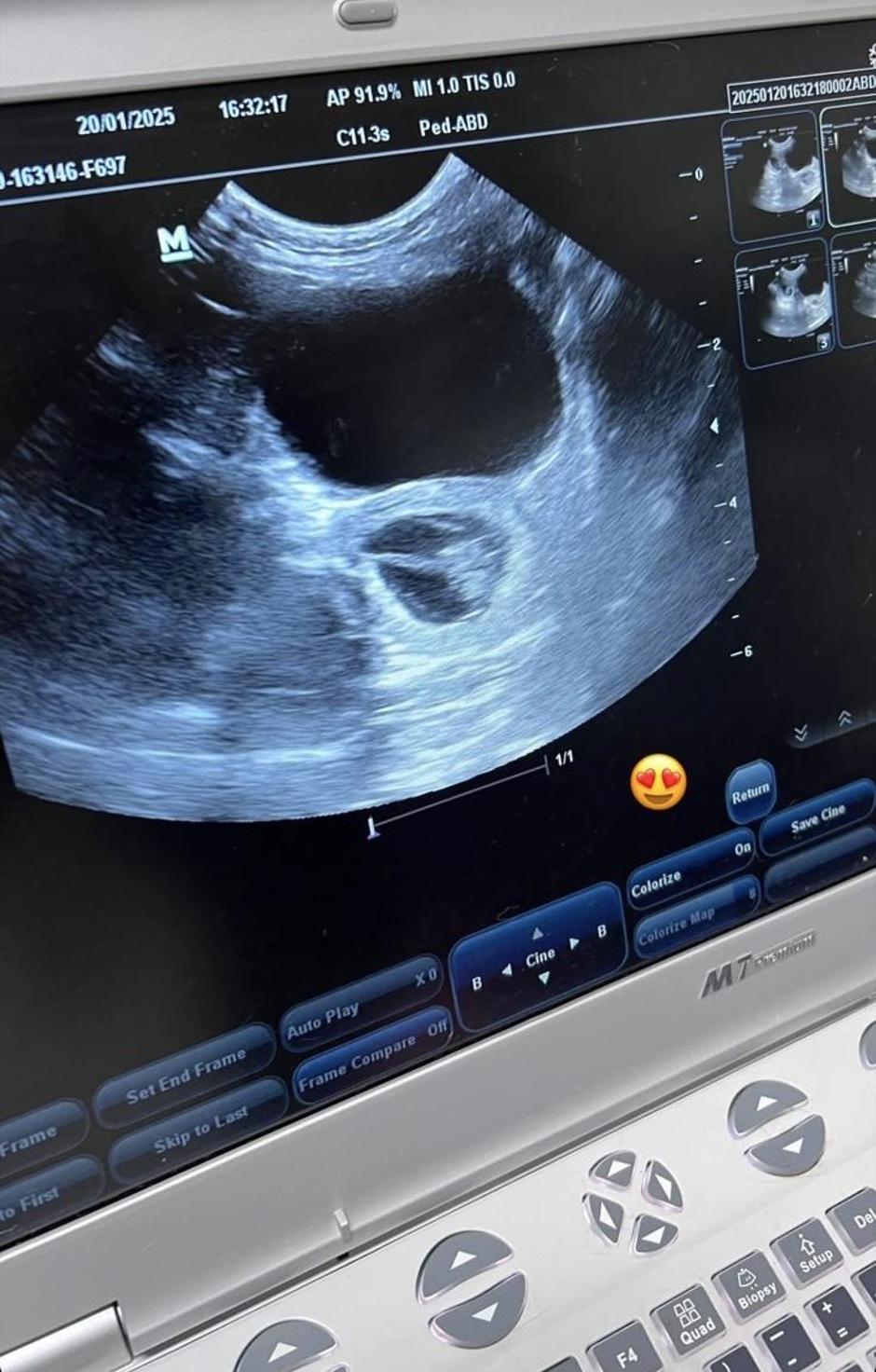 Jan Klobasa ultrazvok | Avtor: instagram