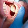 Zobje zobozdravnik karies