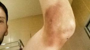 jakov fak komolec poškodba