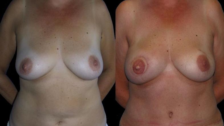 Levo fotografija bolnice z rakom dojke pred operacijo, desno po operaciji. Za no