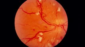 diabetična retinopatija