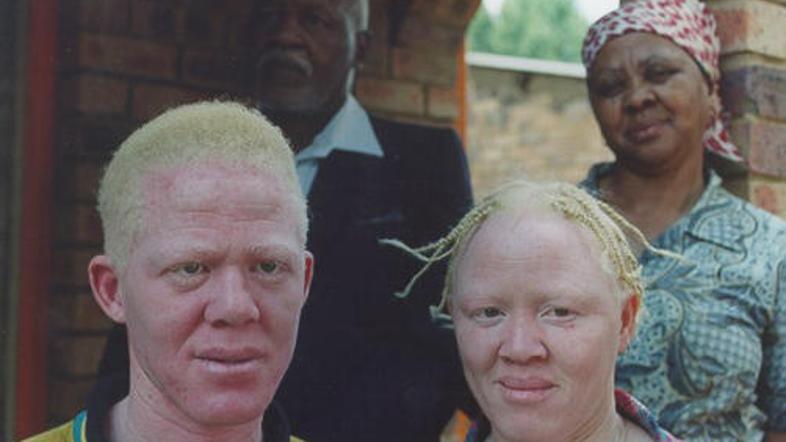 V Tanzaniji je registriranih 4000 albinov, oblasti pa predvidevajo, da jih v drž