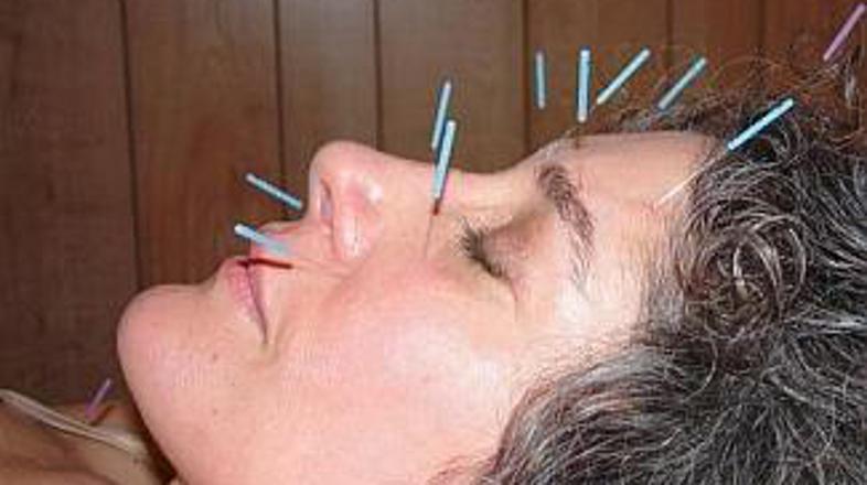 Ena od priljubljenih alternativnih metod zdravljenja je tudi akupunktura.