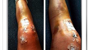 Vonn kolena koleni poškodba operacija smučanje SP Schladming