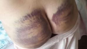 Reece Thompson, napad