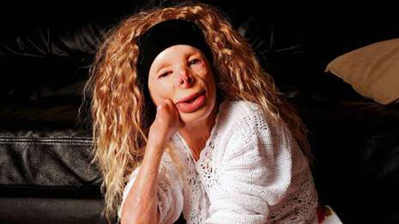 Terri previdno nasloni opečeni obraz na iznakažene roke. Njeno telo je prekrito 