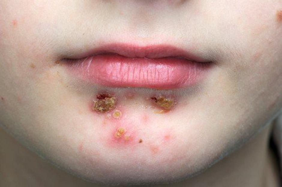 Impetigo | Avtor: Profimedia