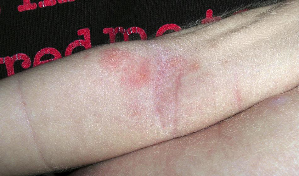 Opazili so jih tudi v Sloveniji, povzročajo hude bolečine