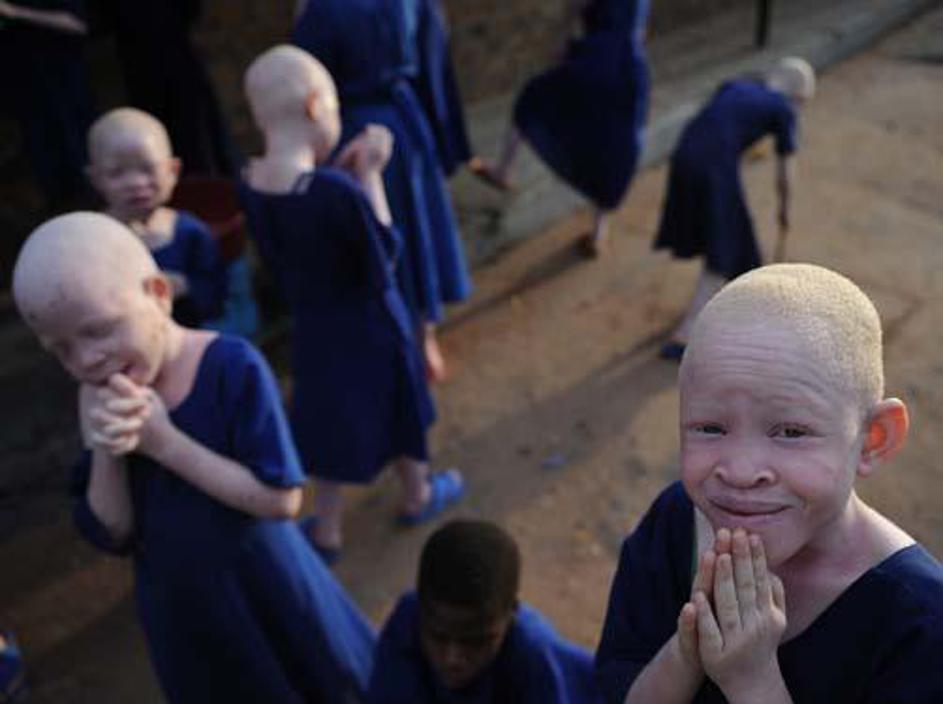 Albino otroci so pogosto tarče napadalcev, ki jih hladnokrvo ubijejo in razkosaj