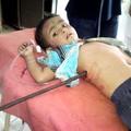 Mali Mihir je kljub nesreči ostal zelo pogumen, so povedali zdravniki.
