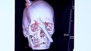 Preživel s palico v glavi 