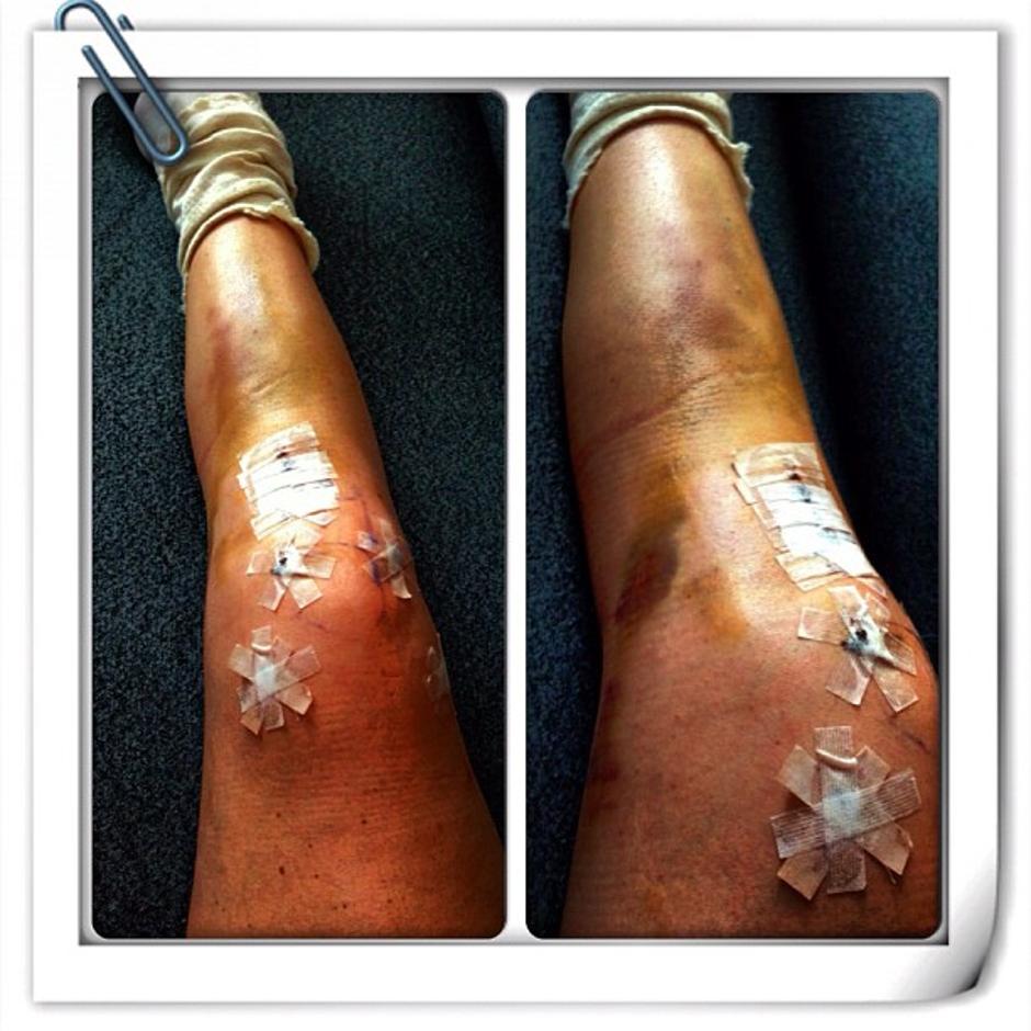 Vonn kolena koleni poškodba operacija smučanje SP Schladming | Avtor: Facebook