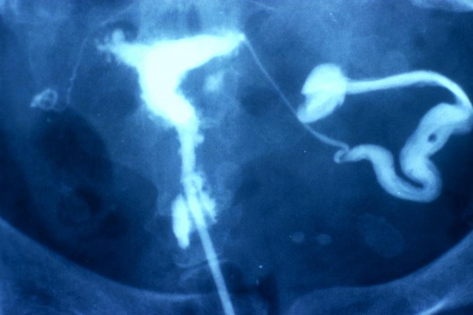 Endometrioza | Avtor: Profimedias