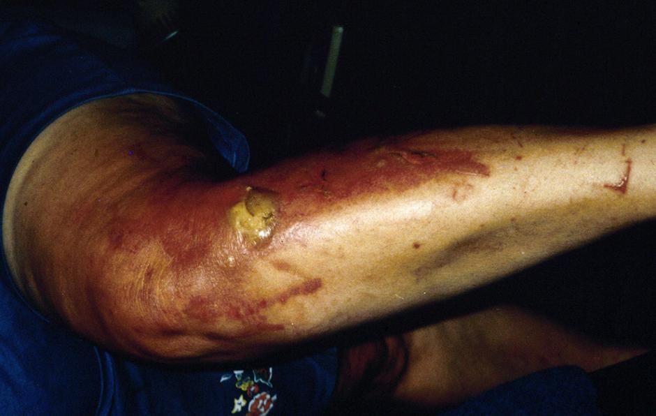Orjaški dežen, Poškodbe na koži | Avtor: USDA APHIS PPQ Archive