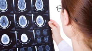 Za magnetno resonanco, opravljeno v tujini, bo ZZZS na podlagi napotnice in raču