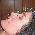 Ena od priljubljenih alternativnih metod zdravljenja je tudi akupunktura.