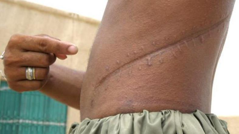 Turški kirurg Jusuf Ercin Sonmez zavrnil obtožbe, da naj bi opravljal presaditve