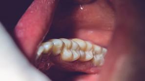 Sowelo, plobma, zobje, amalgam